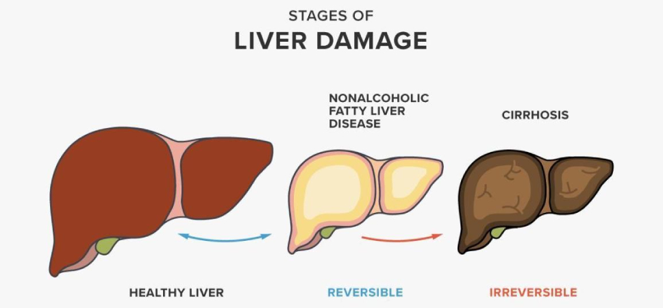 Stages of Liver Damage